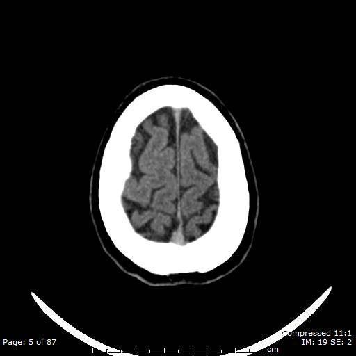 Cerebellar hemangioblastoma (Radiopaedia 52360-58258 Axial non-contrast 5).jpg