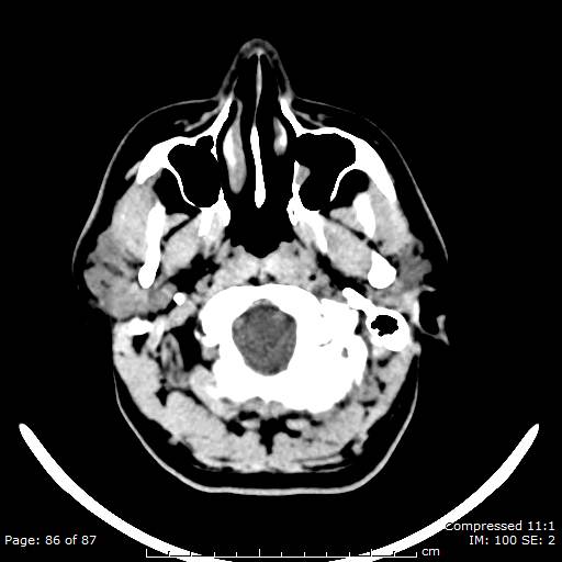 Cerebellar hemangioblastoma (Radiopaedia 52360-58258 Axial non-contrast 86).jpg