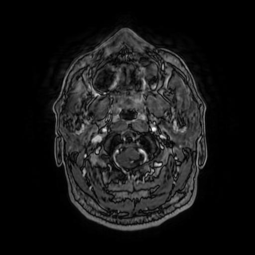 Cerebellar hemangioblastoma (Radiopaedia 88055-104622 Axial T1 C+ 25).jpg