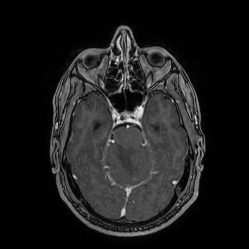 File:Cerebellar hemangioblastoma (Radiopaedia 88055-104622 Axial T1 C+ 70).jpg