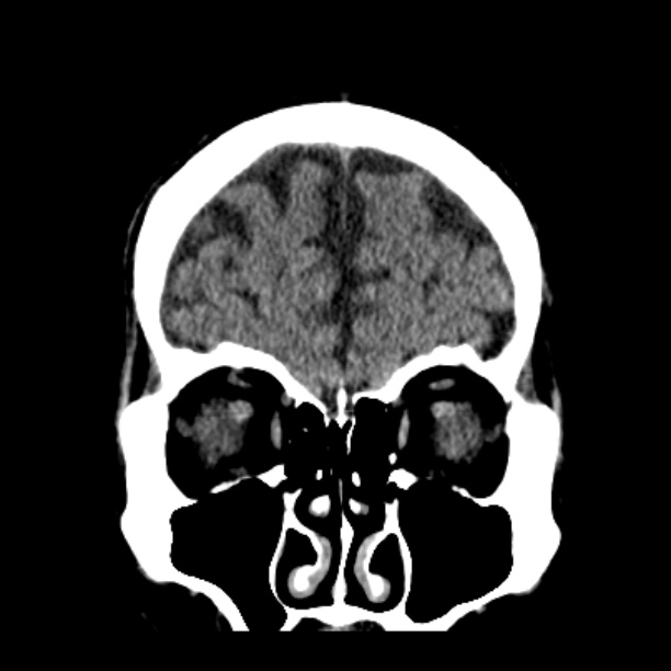Cerebellar hemorrhage (Radiopaedia 27193-27359 Coronal non-contrast 13).jpg