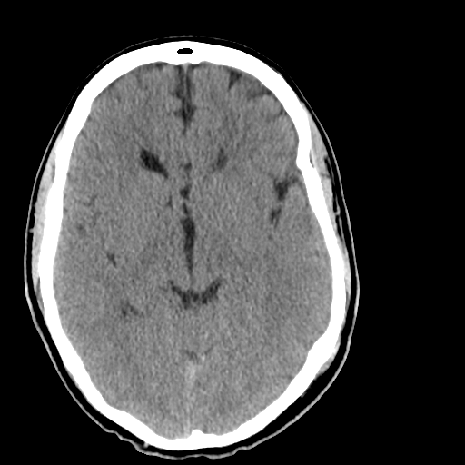 File:Cerebellar infarct due to vertebral artery dissection with posterior fossa decompression (Radiopaedia 82779-97029 Axial non-contrast 12).png