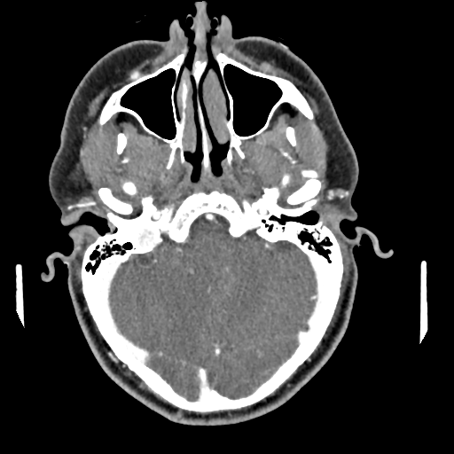 Cerebellar infarct due to vertebral artery dissection with posterior fossa decompression (Radiopaedia 82779-97029 C 23).png