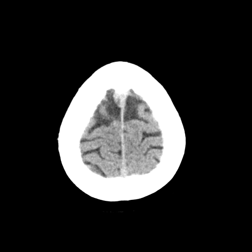 Cerebellar metastasis (Radiopaedia 54578-60812 Axial non-contrast 45).png
