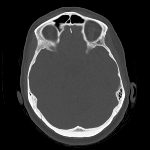 Cerebellar metastasis (cystic appearance) (Radiopaedia 41395-44258 Axial bone window 23).png
