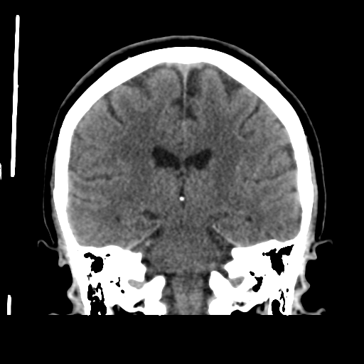 Cerebellar metastasis (cystic appearance) (Radiopaedia 41395-44258 Coronal non-contrast 37).png