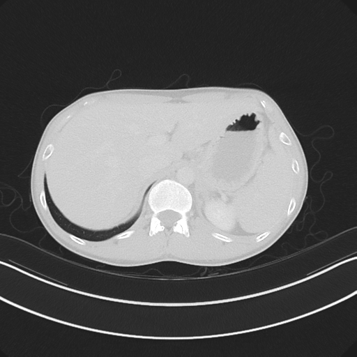 Cerebellar metastasis - adenocarcinoma lung (Radiopaedia 63184-71717 Axial lung window 66).png