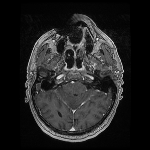 Cerebellar metastasis of pulmonary adenocarcinoma, cavernous venous malformation, and developmental venous anomaly (Radiopaedia 85827-101661 Axial T1 C+ 34).jpg