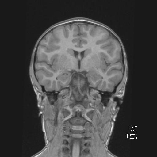 Cerebellar stroke (Radiopaedia 32202-33150 Coronal T1 29).png