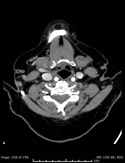 Cerebellar strokes due to intracranial giant cell arteritis (Radiopaedia 68799-78510 CT angiogram 108).jpg