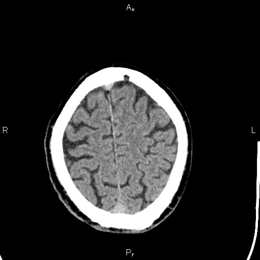 Cerebellopontine angle arachnoid cyst (Radiopaedia 85149-100704 Axial With contrast 43).jpg