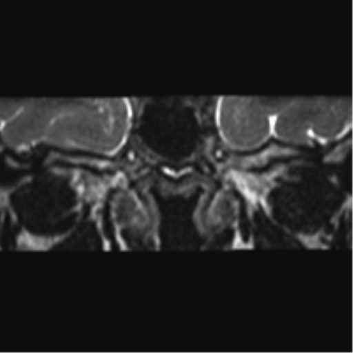 Cerebellopontine angle meningioma (Radiopaedia 48434-53348 Coronal T2 81).png