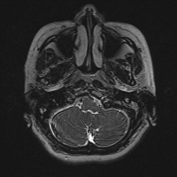 Cerebellopontine angle meningioma (Radiopaedia 53561-59591 Axial 3D volume T2 27).jpg