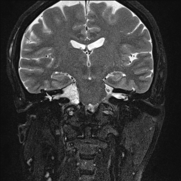 File:Cerebellopontine angle meningioma (Radiopaedia 53561-59591 Coronal T2 11).jpg