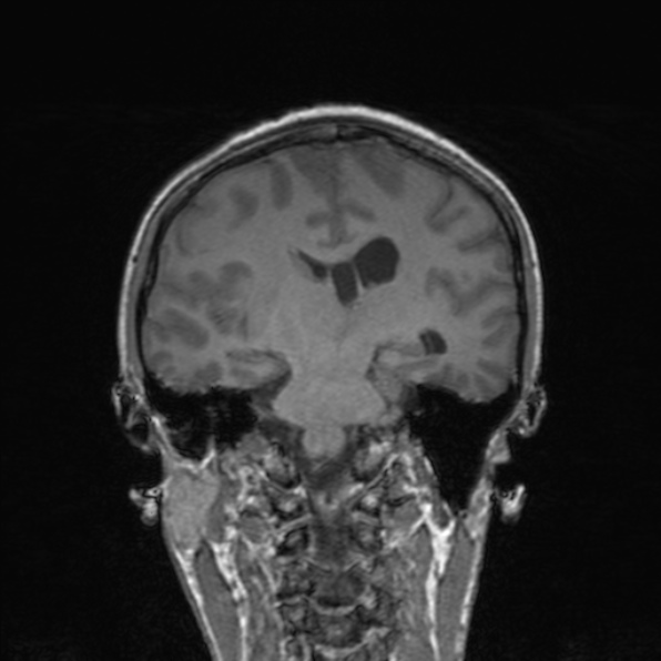 Cerebral abscess (Radiopaedia 24212-24478 Coronal T1 123).jpg