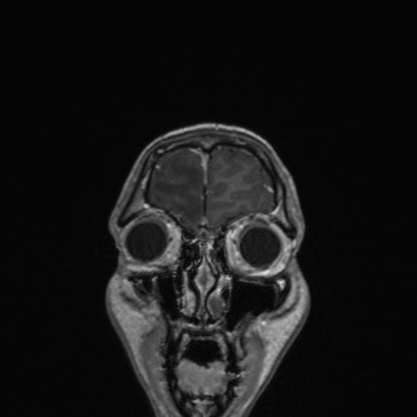 Cerebral abscess (Radiopaedia 24212-24478 Coronal T1 C+ 40).jpg