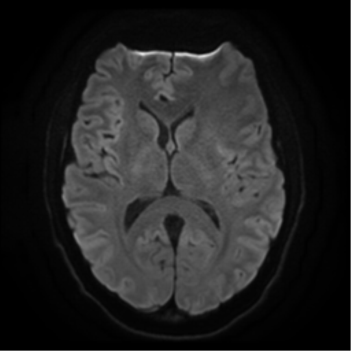 Cerebral abscess (Radiopaedia 57774-64740 Axial DWI 15).png