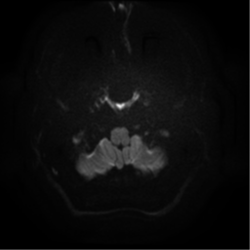 Cerebral abscess (Radiopaedia 57774-64740 Axial DWI 2).png