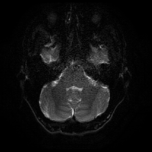 Cerebral abscess (Radiopaedia 57774-64740 Axial DWI 34).png