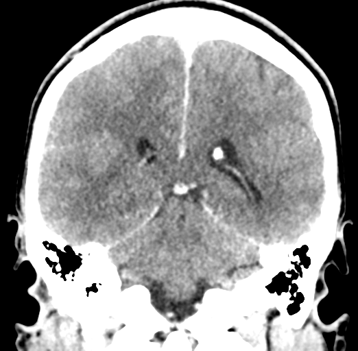 File:Cerebral abscess (Radiopaedia 60342-68008 Coronal C+ delayed 42).png