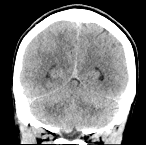 Cerebral abscess (Radiopaedia 60342-68008 Coronal non-contrast 47).png