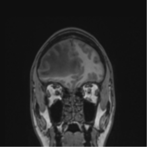 Cerebral abscess (Radiopaedia 60342-68009 Coronal T1 44).png