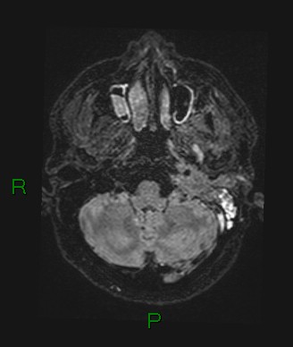 Cerebral abscess and subdural empyema (Radiopaedia 84436-99779 Axial FLAIR 68).jpg