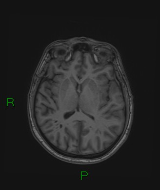 Cerebral abscess and subdural empyema (Radiopaedia 84436-99779 Axial T1 41).jpg
