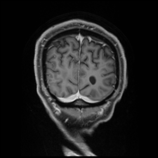 Cerebral abscess with ventriculitis (Radiopaedia 78965-91878 Coronal T1 C+ 56).jpg