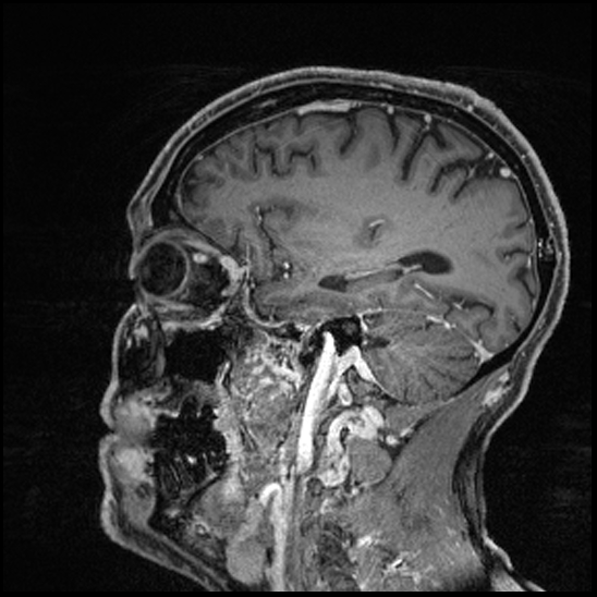 Cerebral abscess with ventriculitis (Radiopaedia 78965-91878 Sagittal T1 C+ 126).jpg