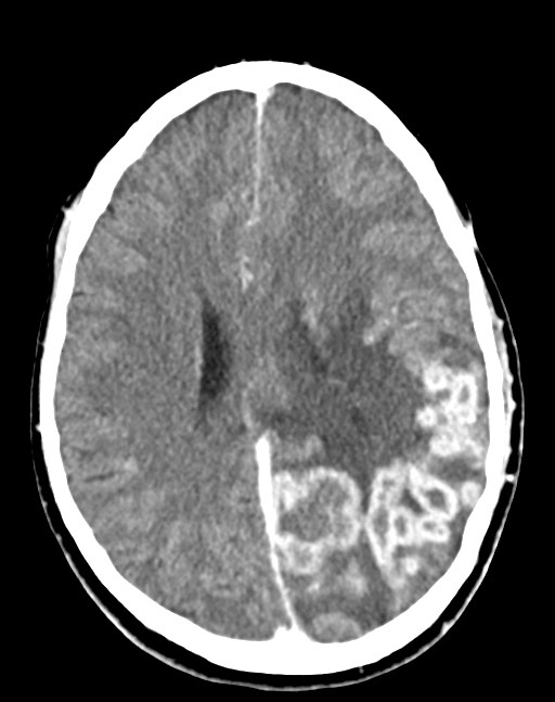Cerebral abscesses (Radiopaedia 70458-80568 Axial Contrast 39).jpg