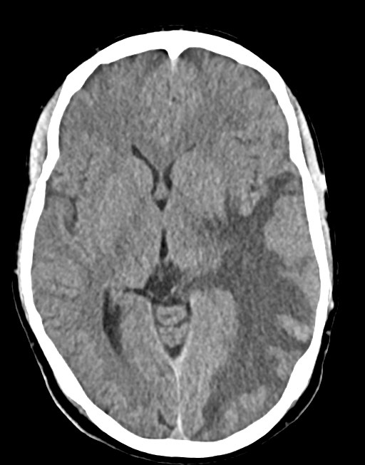 Cerebral abscesses (Radiopaedia 70458-80568 Axial non-contrast 31).jpg