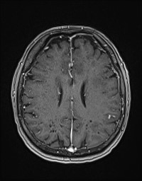 Cerebral amyloid angiopathy-related inflammation (Radiopaedia 58270-65377 Axial T1 C+ fat sat 97).jpg
