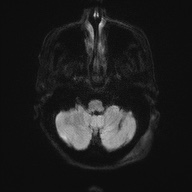 Cerebral amyloid angiopathy-related inflammation (Radiopaedia 74836-85849 Axial DWI 36).jpg