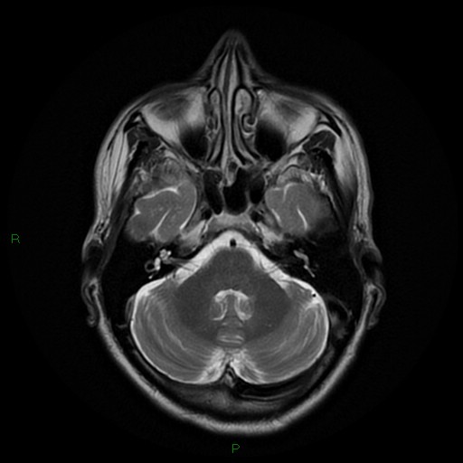File:Cerebral amyloid angiopathy (Radiopaedia 77506-89664 Axial T2 8).jpg