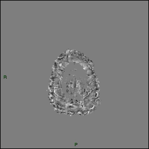 Cerebral amyloid angiopathy (Radiopaedia 77506-89664 H 100).jpg