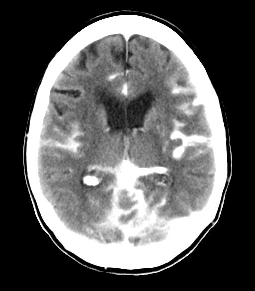 File:Cerebral aneurysm with rupture (Radiopaedia 29933-30460 Axial non-contrast 14).jpg