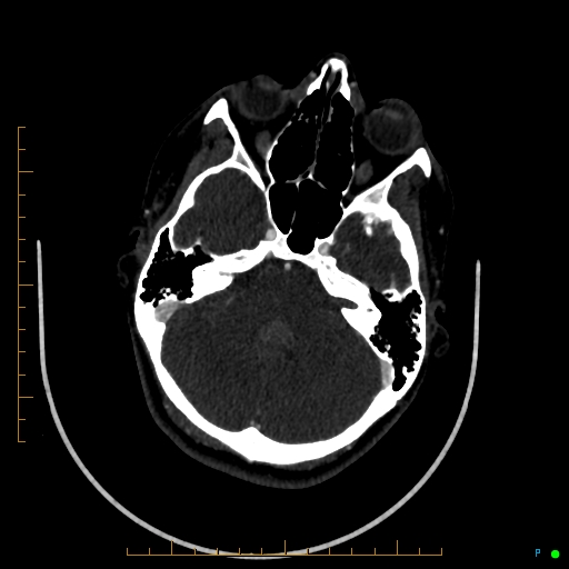 Cerebral arteriovenous malformation (AVM) (Radiopaedia 78162-90706 Axial CTA 86).jpg