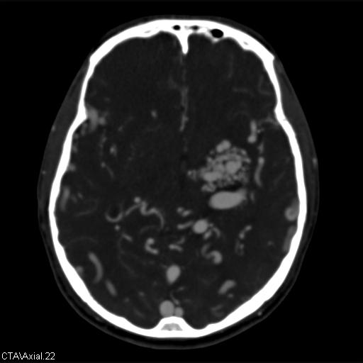 Cerebral arteriovenous malformation (Radiopaedia 28518-28759 B 22).jpg
