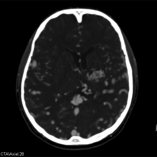 Cerebral arteriovenous malformation (Radiopaedia 28518-28759 B 28).jpg