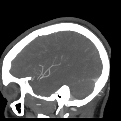 Cerebral arteriovenous malformation (Radiopaedia 39259-41505 Sagittal 47).png