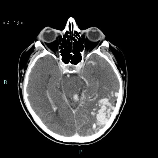 File:Cerebral arteriovenous malformation (Radiopaedia 40528-43125 Axial C+ delayed 13).jpg