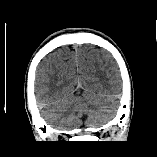 Cerebral arteriovenous malformation (Radiopaedia 61964-70028 Coronal non-contrast 49).jpg