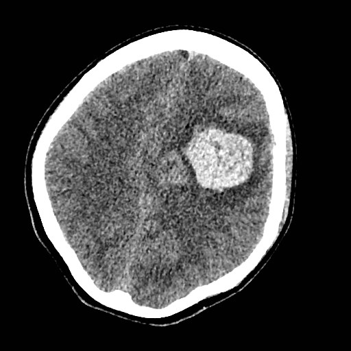 Cerebral arteriovenous malformation (Radiopaedia 79677-92887 Axial non-contrast 27).jpg