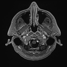 Cerebral arteriovenous malformation (Radiopaedia 84015-99245 Axial T1 C+ 24).jpg