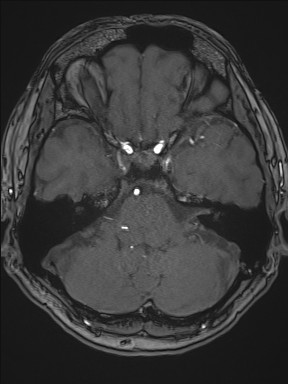 File:Cerebral arteriovenous malformation (Radiopaedia 84015-99245 Axial TOF 82).jpg