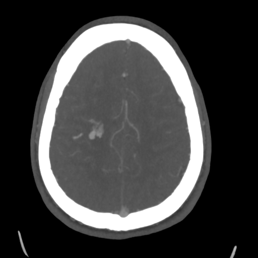 Cerebral arteriovenous malformation (Spetzler-Martin grade 2) (Radiopaedia 41262-44076 E 41).png