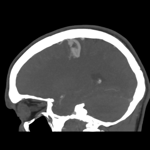 Cerebral arteriovenous malformation (Spetzler-Martin grade 2) (Radiopaedia 41262-44076 G 20).png