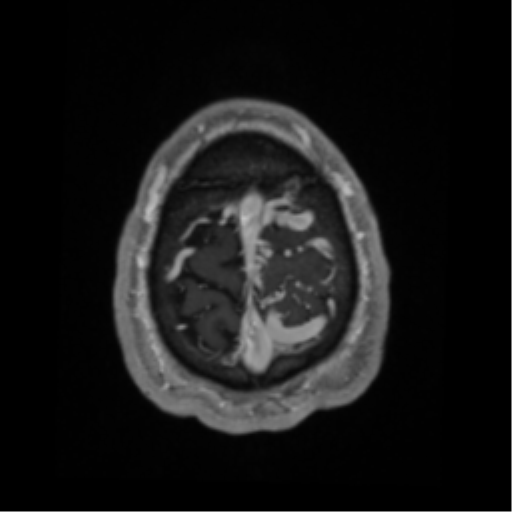 Cerebral arteriovenous malformation - huge (Radiopaedia 35734-37272 Axial T1 C+ 69).png