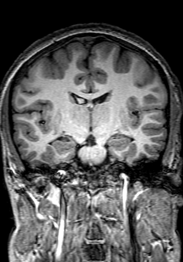 Cerebral arteriovenous malformation at posterior body of corpus callosum (Radiopaedia 74111-84925 Coronal T1 165).jpg